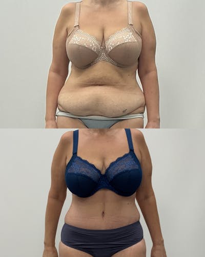 Post-Bariatric Body Contouring Before & After Gallery - Patient 479742 - Image 1