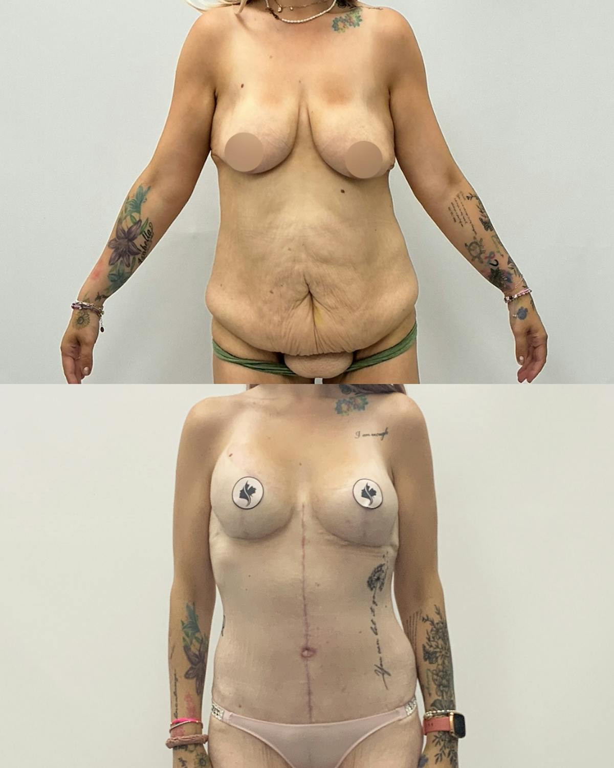 Mommy Makeover Before & After Gallery - Patient 140151 - Image 1