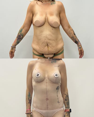 Mommy Makeover Before & After Gallery - Patient 140151 - Image 1