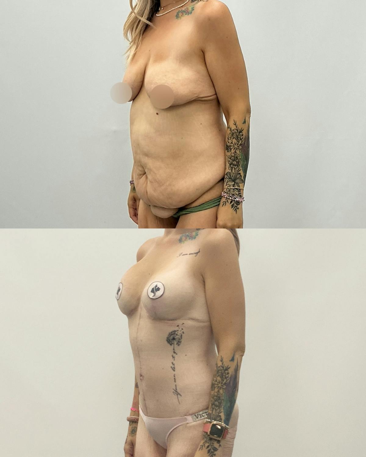 Mommy Makeover Before & After Gallery - Patient 140151 - Image 2