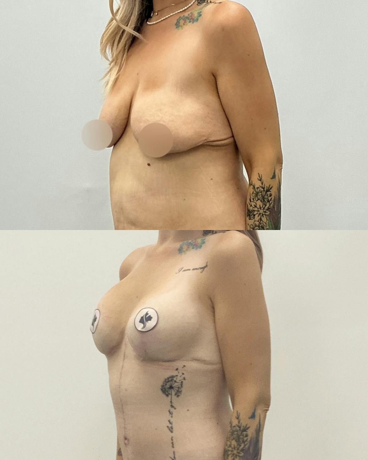 Breast Reduction Before & After Gallery - Patient 286994 - Image 2