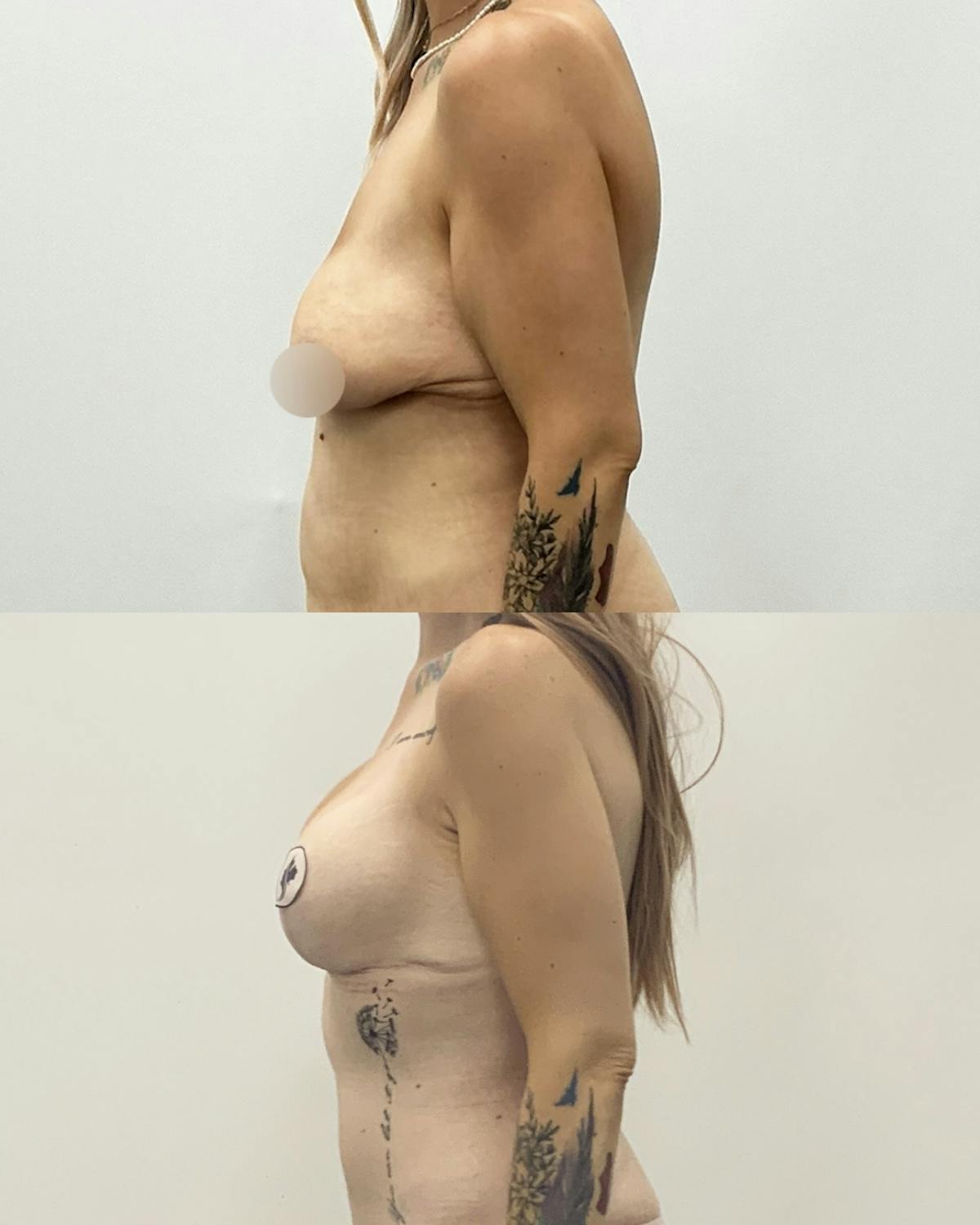Breast Reduction Before & After Gallery - Patient 286994 - Image 3