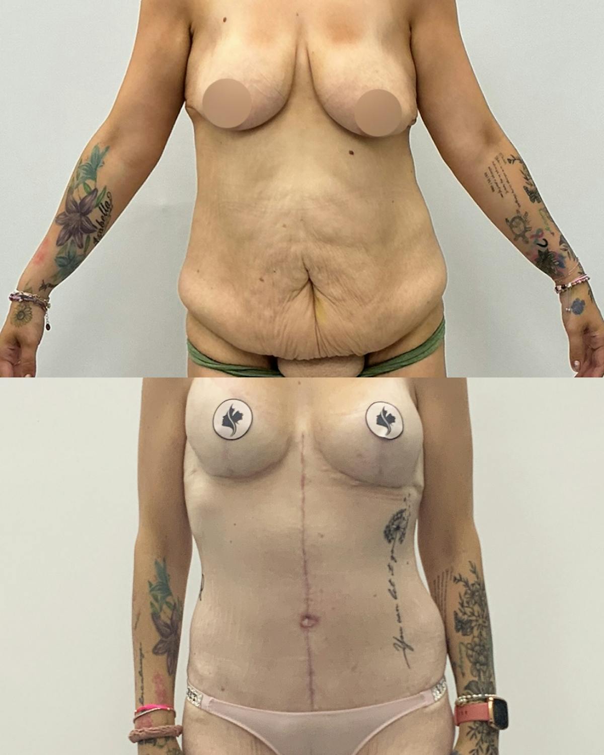 Tummy Tuck Before & After Gallery - Patient 397019 - Image 1