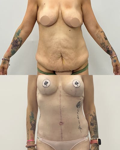 Tummy Tuck Before & After Gallery - Patient 397019 - Image 1