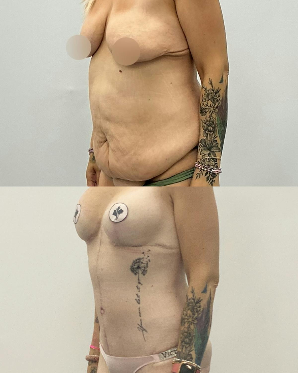 Tummy Tuck Before & After Gallery - Patient 397019 - Image 2