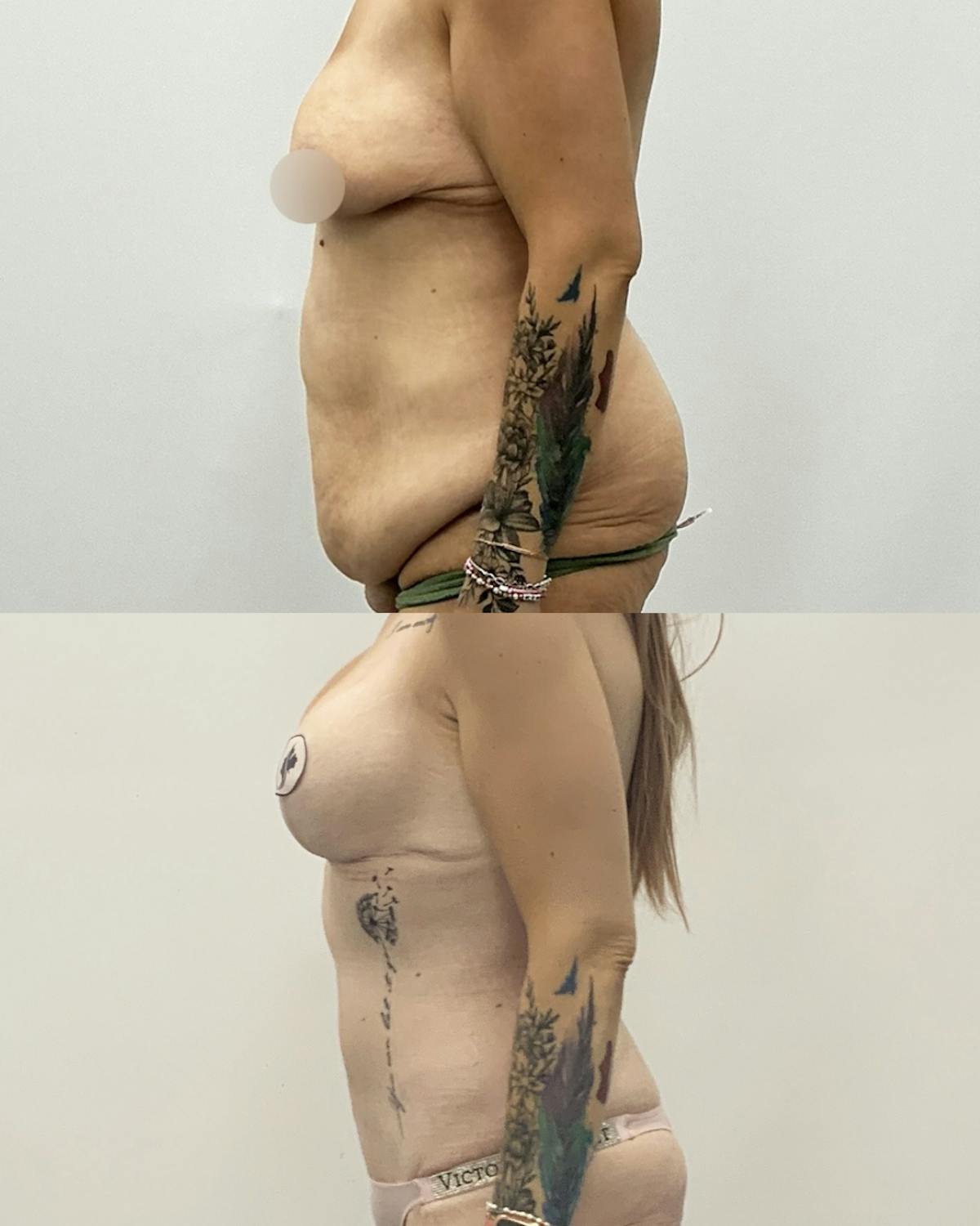 Tummy Tuck Before & After Gallery - Patient 397019 - Image 3