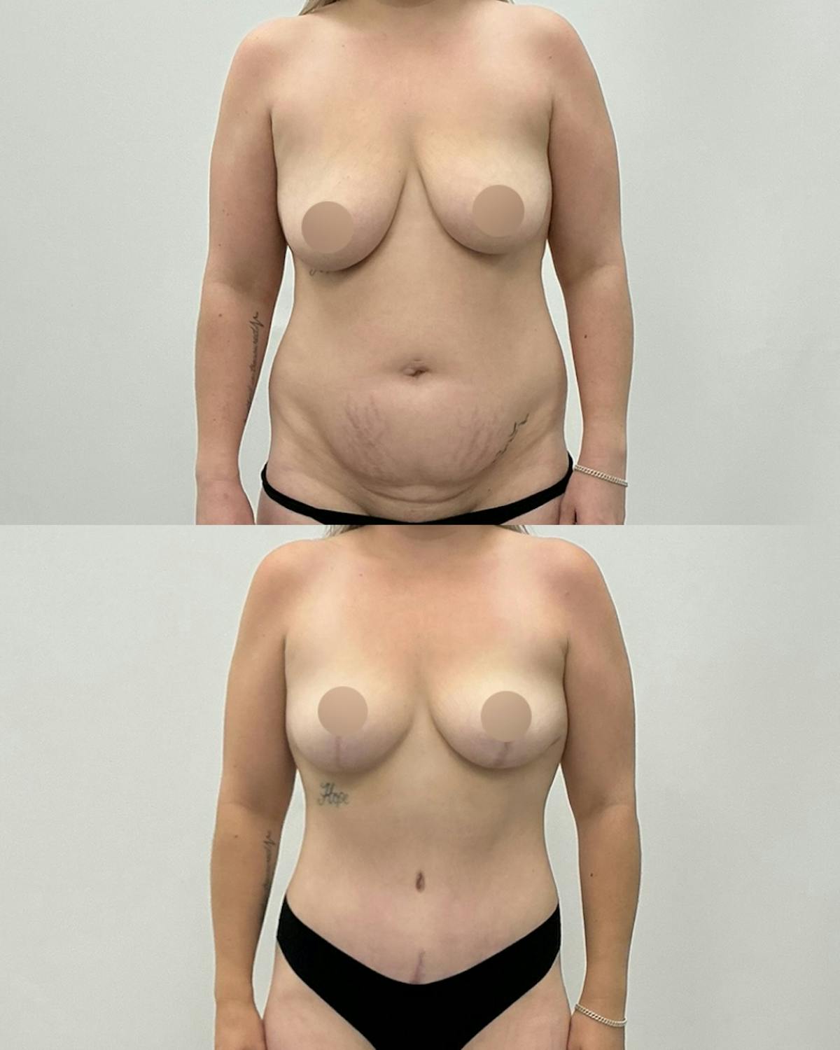 Mommy Makeover Before & After Gallery - Patient 368204 - Image 1