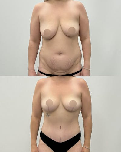 Mommy Makeover Before & After Gallery - Patient 368204 - Image 1