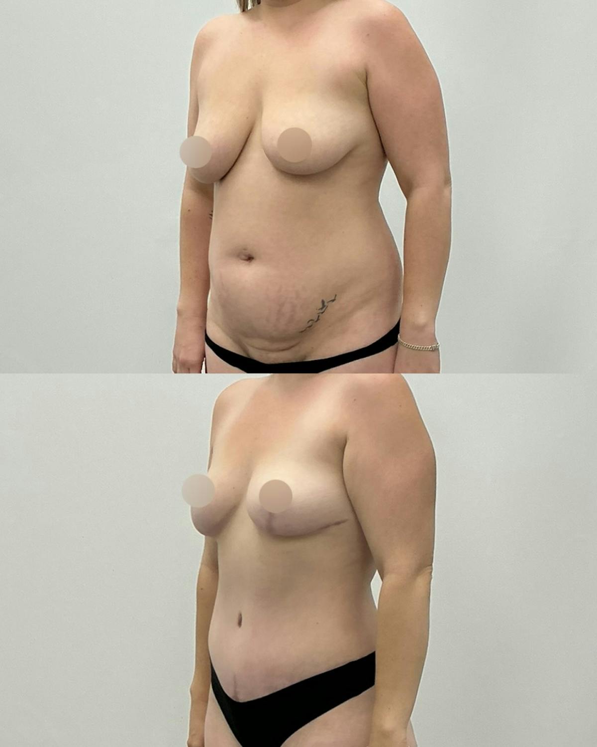 Mommy Makeover Before & After Gallery - Patient 368204 - Image 2