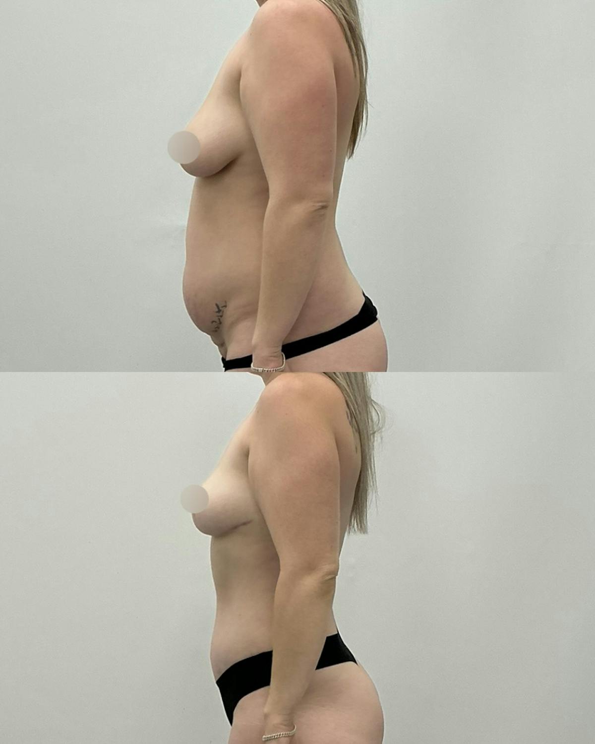 Mommy Makeover Before & After Gallery - Patient 368204 - Image 3