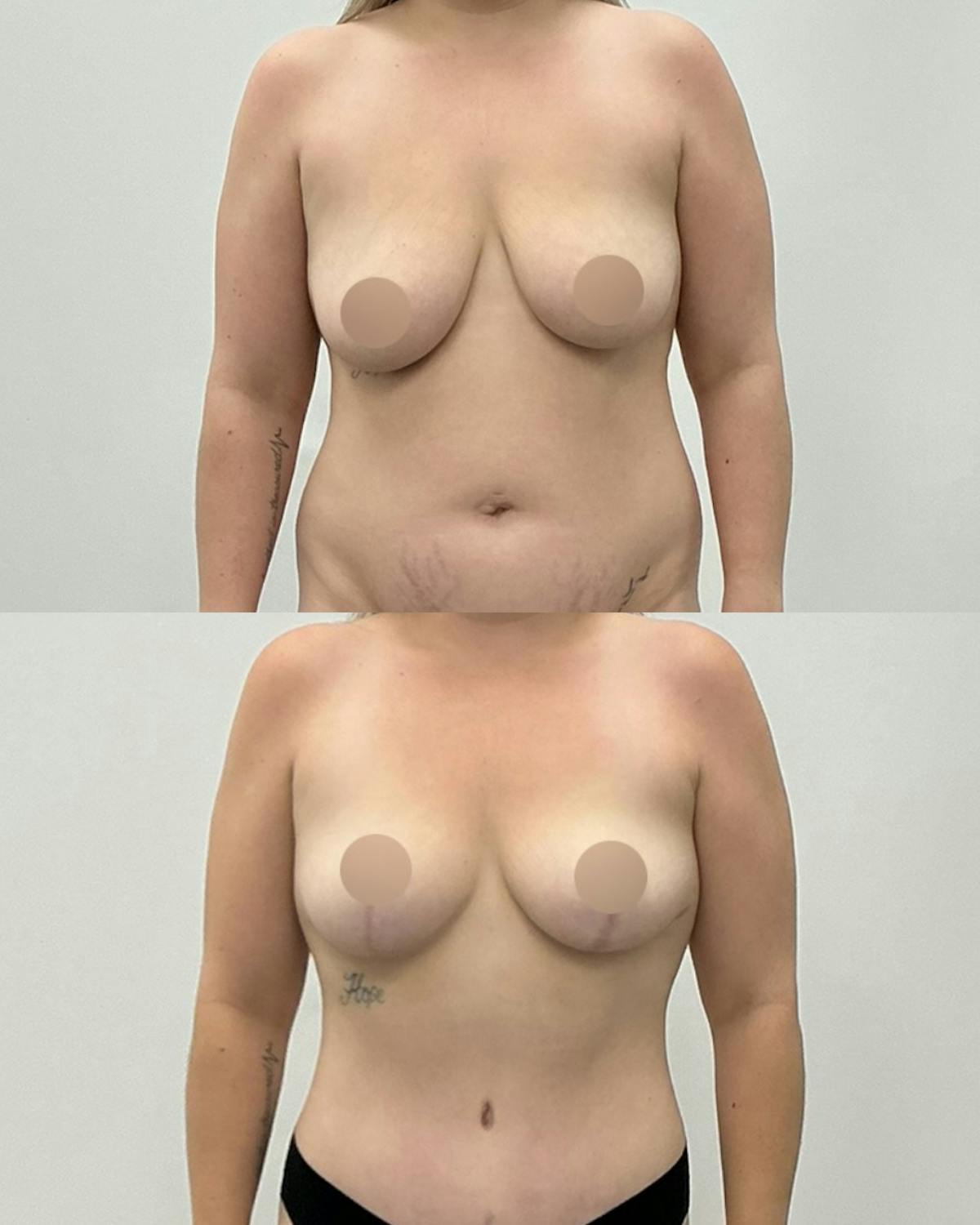 Breast Reduction Before & After Gallery - Patient 148359 - Image 1
