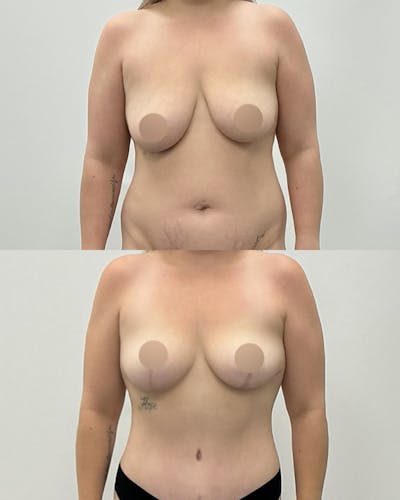 Breast Asymmetry Correction Before & After Gallery - Patient 143572 - Image 1
