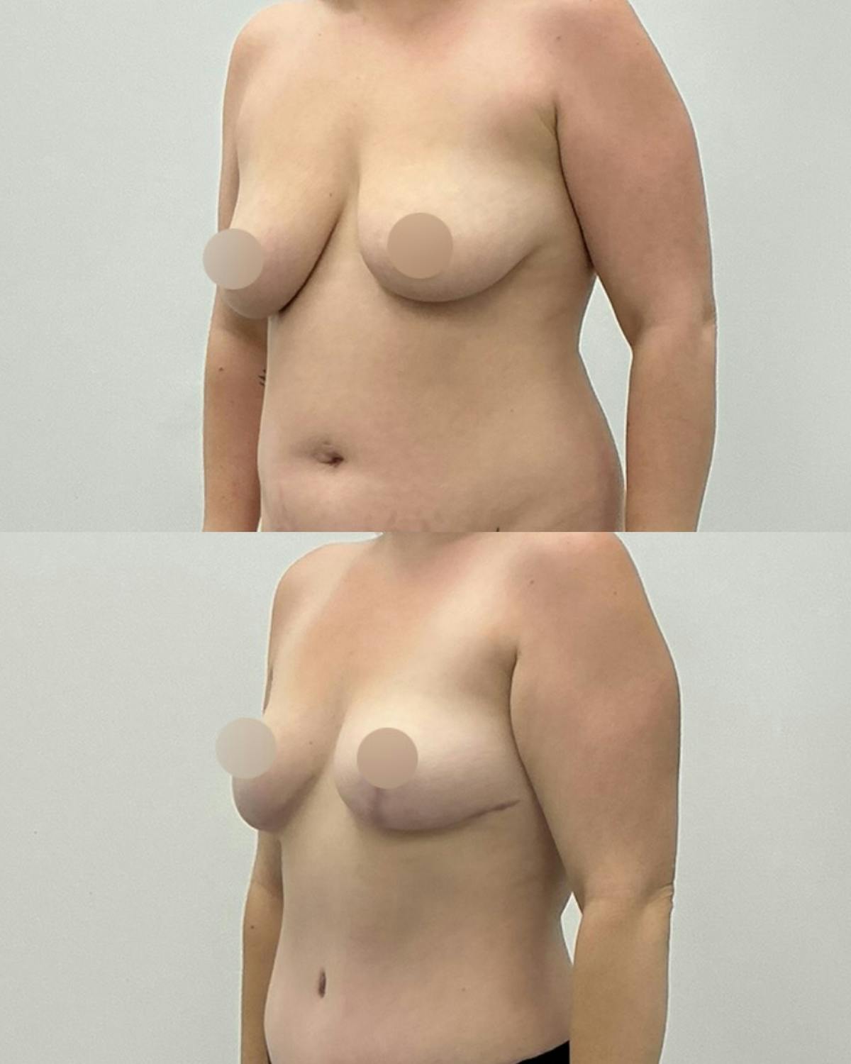 Breast Reduction Before & After Gallery - Patient 148359 - Image 2