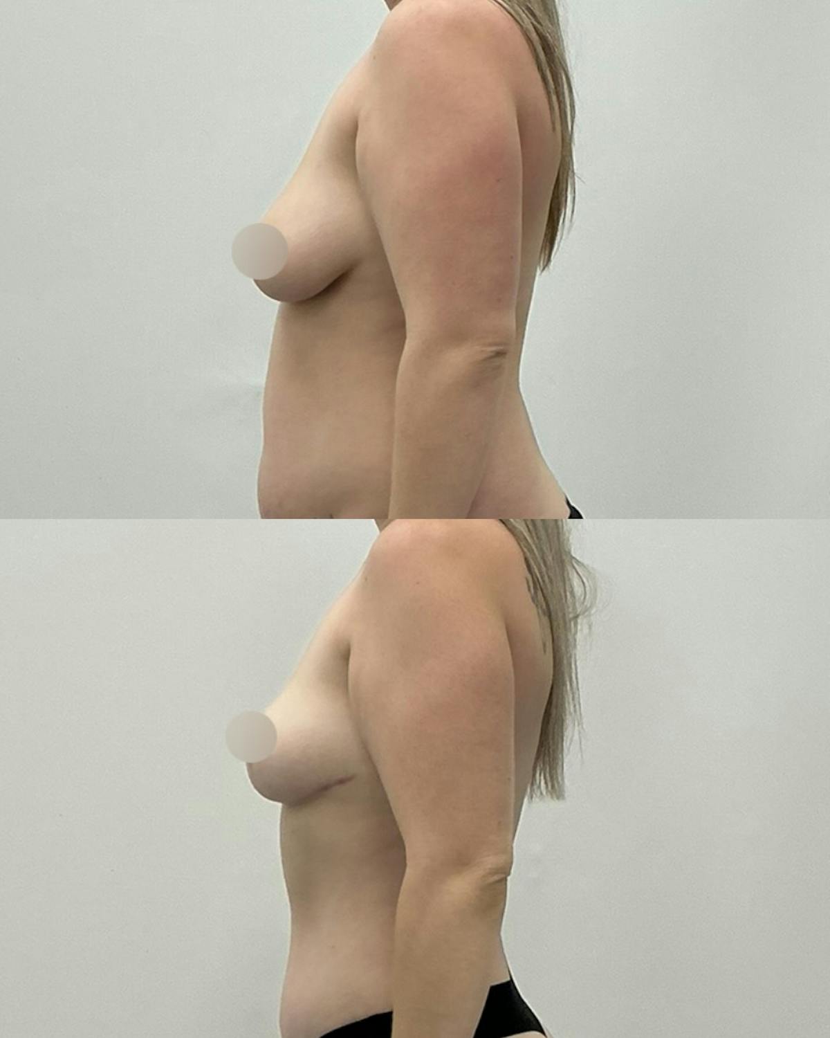 Breast Reduction Before & After Gallery - Patient 148359 - Image 3