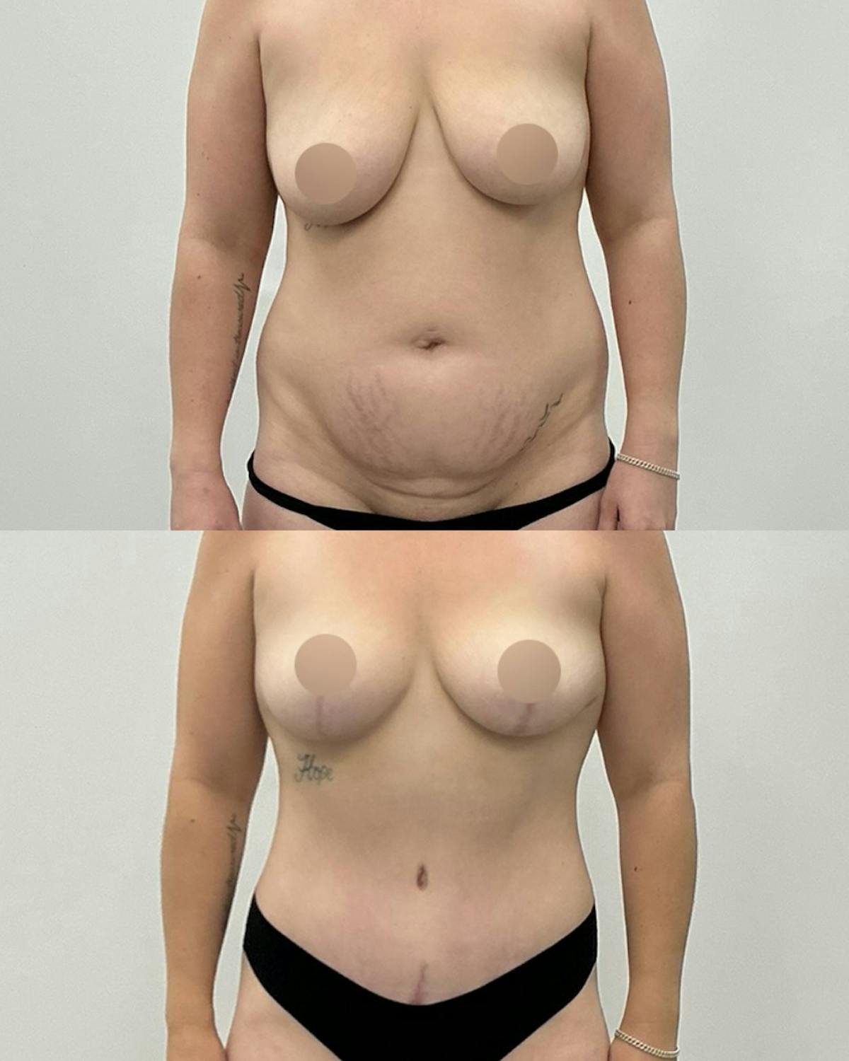 Tummy Tuck Before & After Gallery - Patient 377640 - Image 1