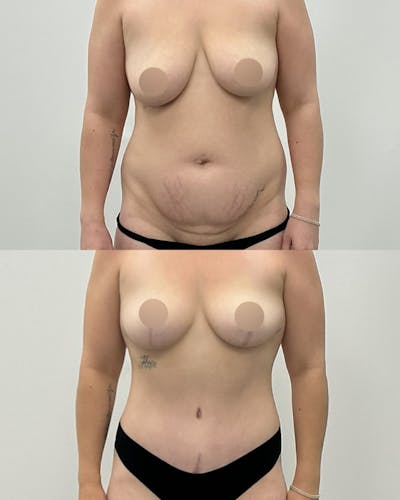 Tummy Tuck Before & After Gallery - Patient 377640 - Image 1