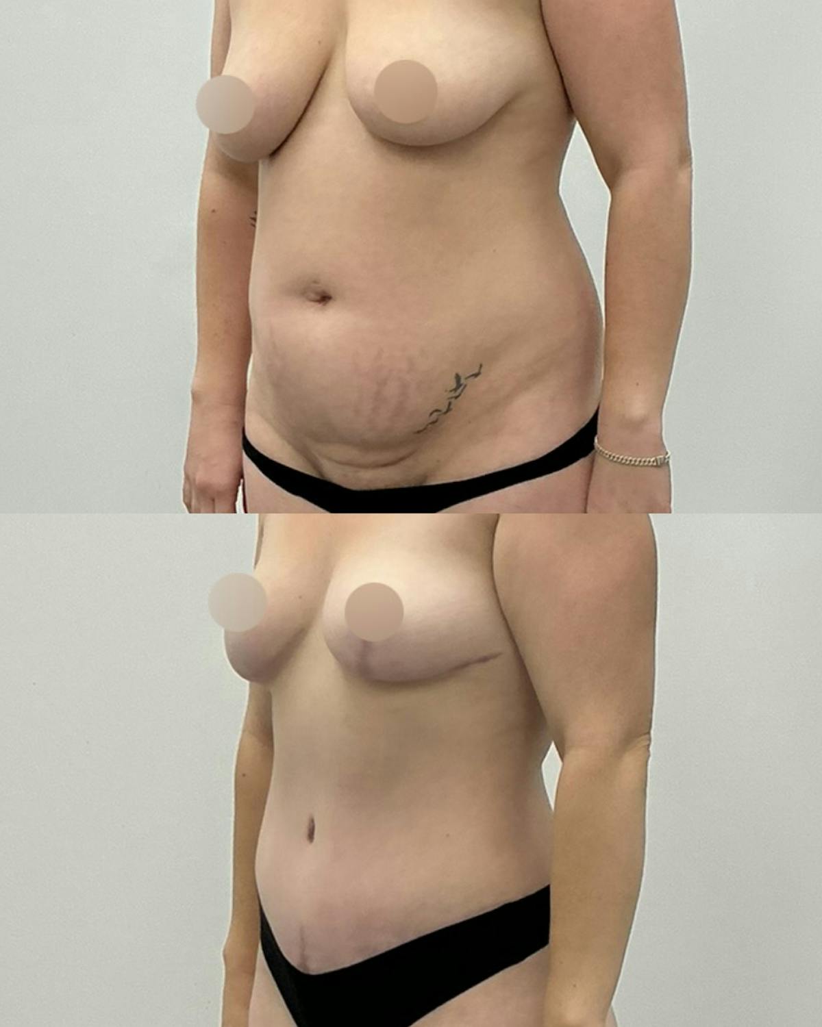 Tummy Tuck Before & After Gallery - Patient 377640 - Image 2