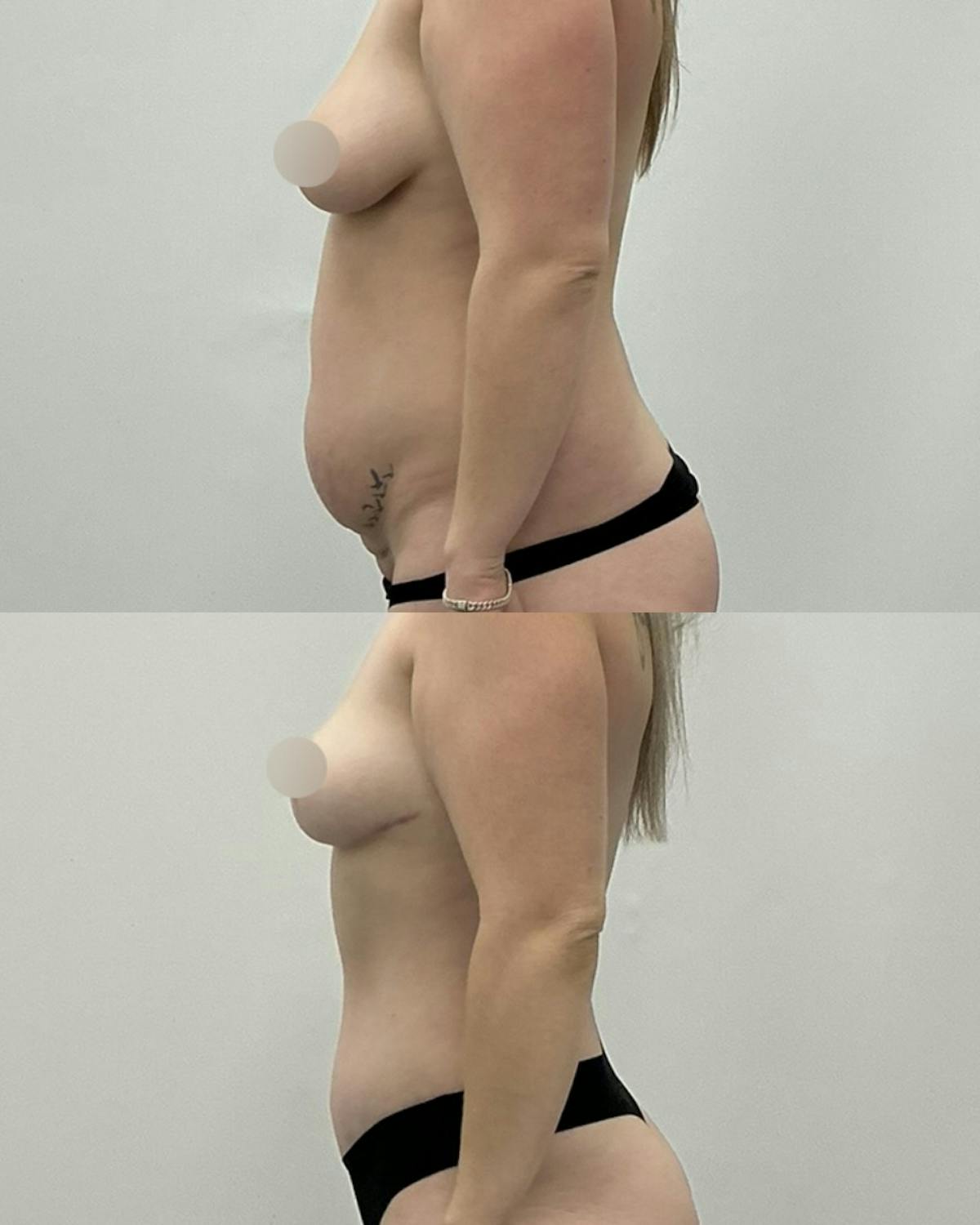 Tummy Tuck Before & After Gallery - Patient 377640 - Image 3