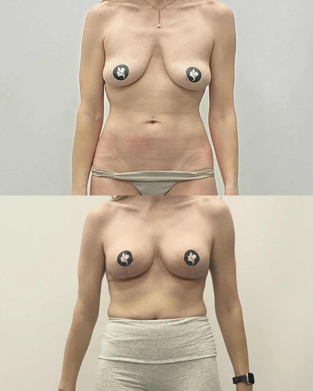 Breast Reduction Before & After Gallery - Patient 232906 - Image 1