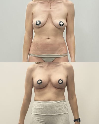 Breast Lift Before & After Gallery - Patient 182155 - Image 1
