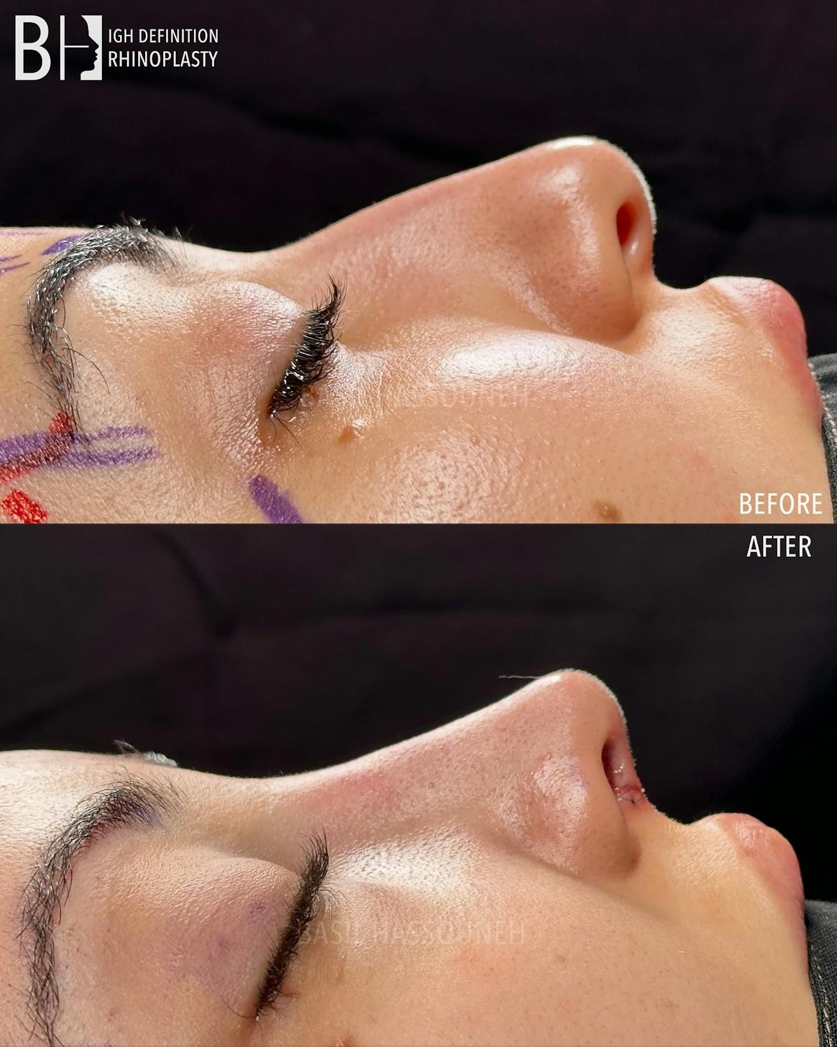 Rhinoplasty Before & After Gallery - Patient 375792 - Image 4