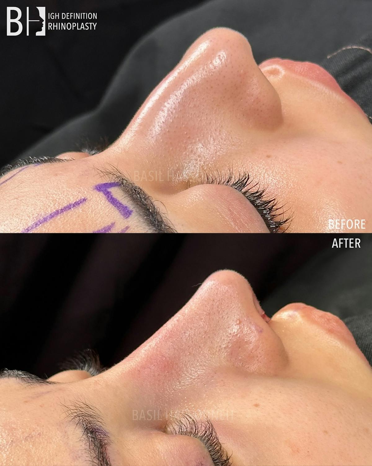 Rhinoplasty Before & After Gallery - Patient 375792 - Image 3