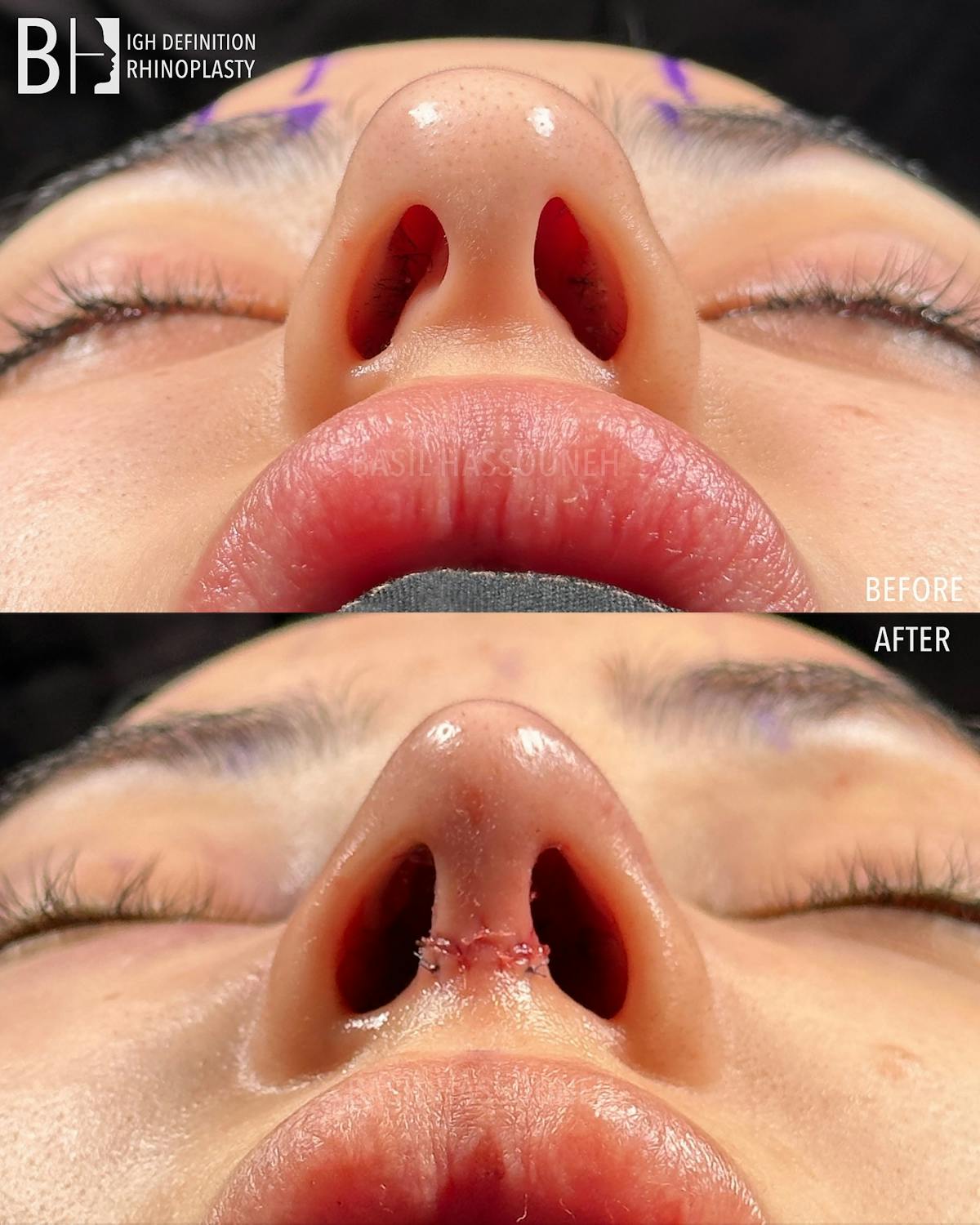Rhinoplasty Before & After Gallery - Patient 375792 - Image 1