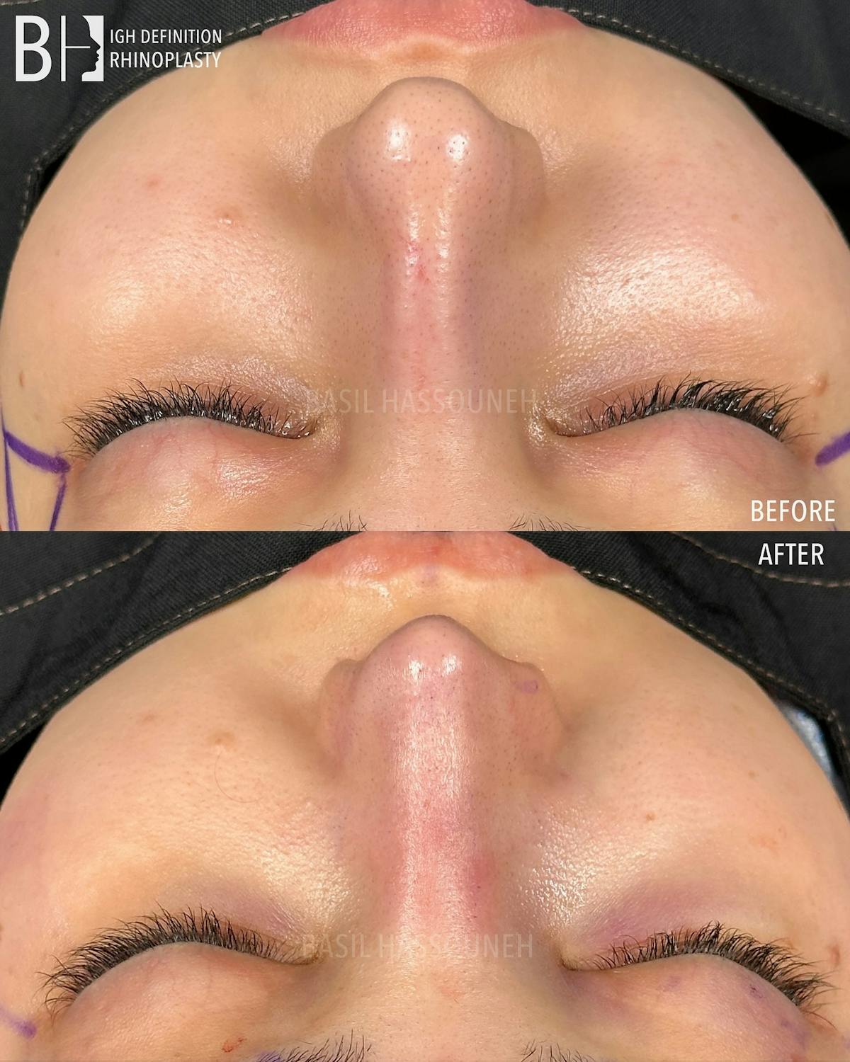 Rhinoplasty Before & After Gallery - Patient 375792 - Image 2