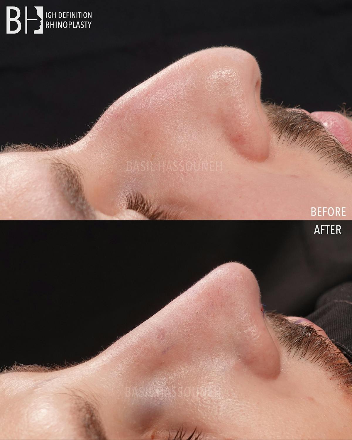 Rhinoplasty Before & After Gallery - Patient 360215 - Image 2