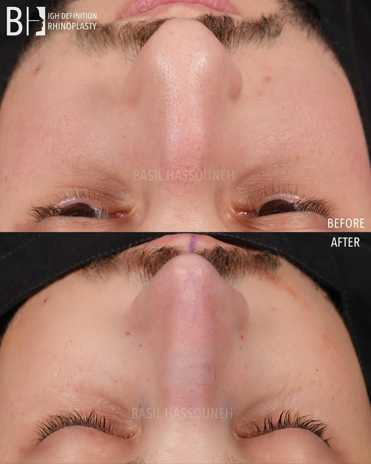Rhinoplasty Before & After Gallery - Patient 360215 - Image 3