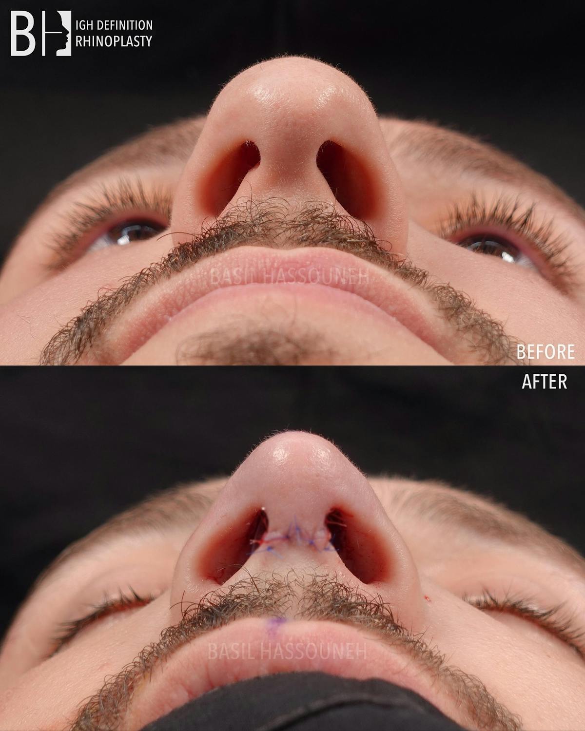 Rhinoplasty Before & After Gallery - Patient 360215 - Image 1