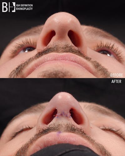 Rhinoplasty Before & After Gallery - Patient 360215 - Image 1