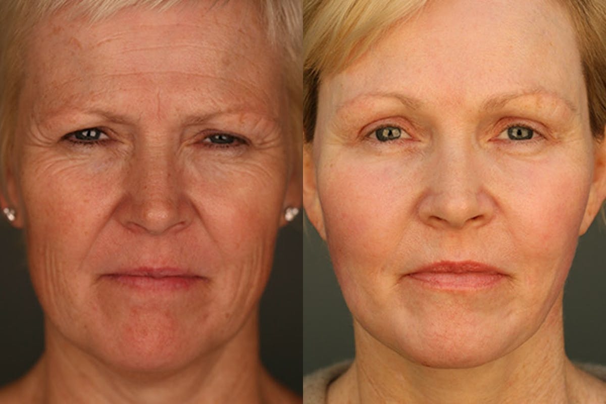 Facelift Before & After Gallery - Patient 428808 - Image 1