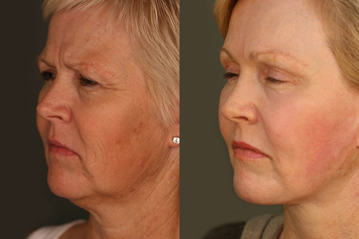 Facelift Before & After Gallery - Patient 428808 - Image 2
