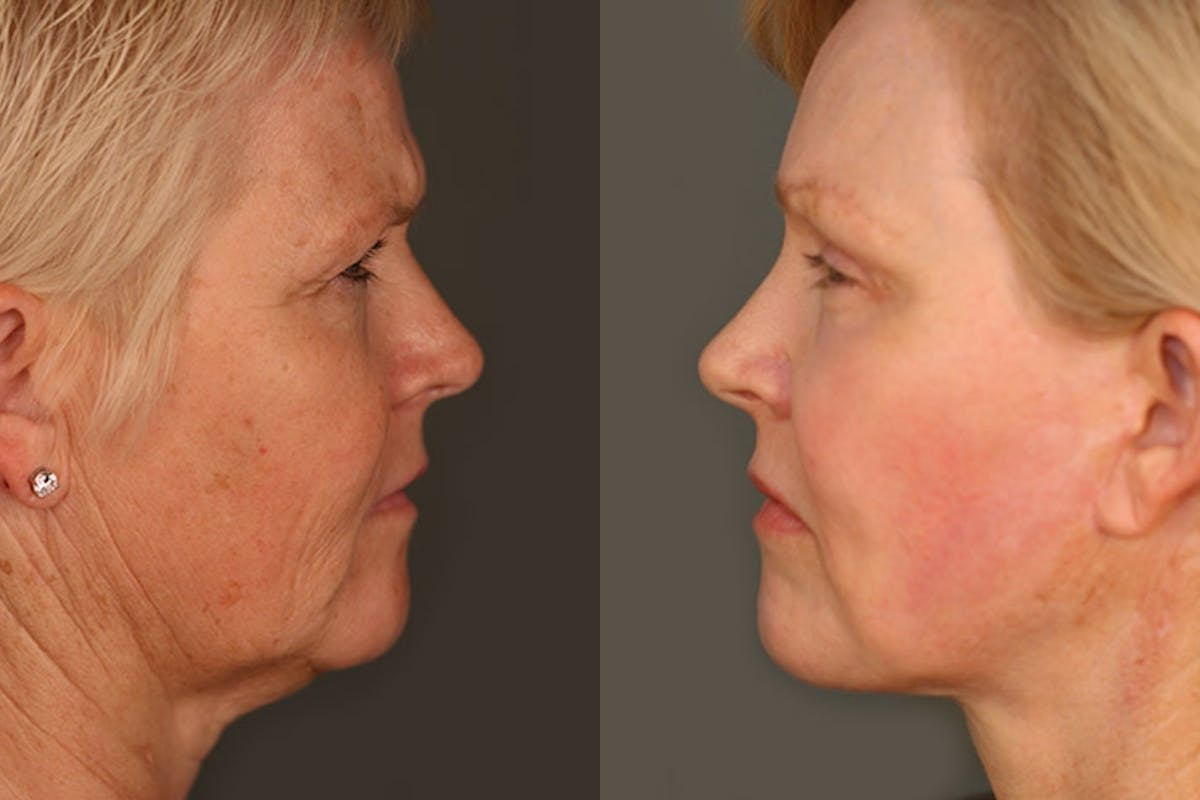 Facelift Before & After Gallery - Patient 428808 - Image 3