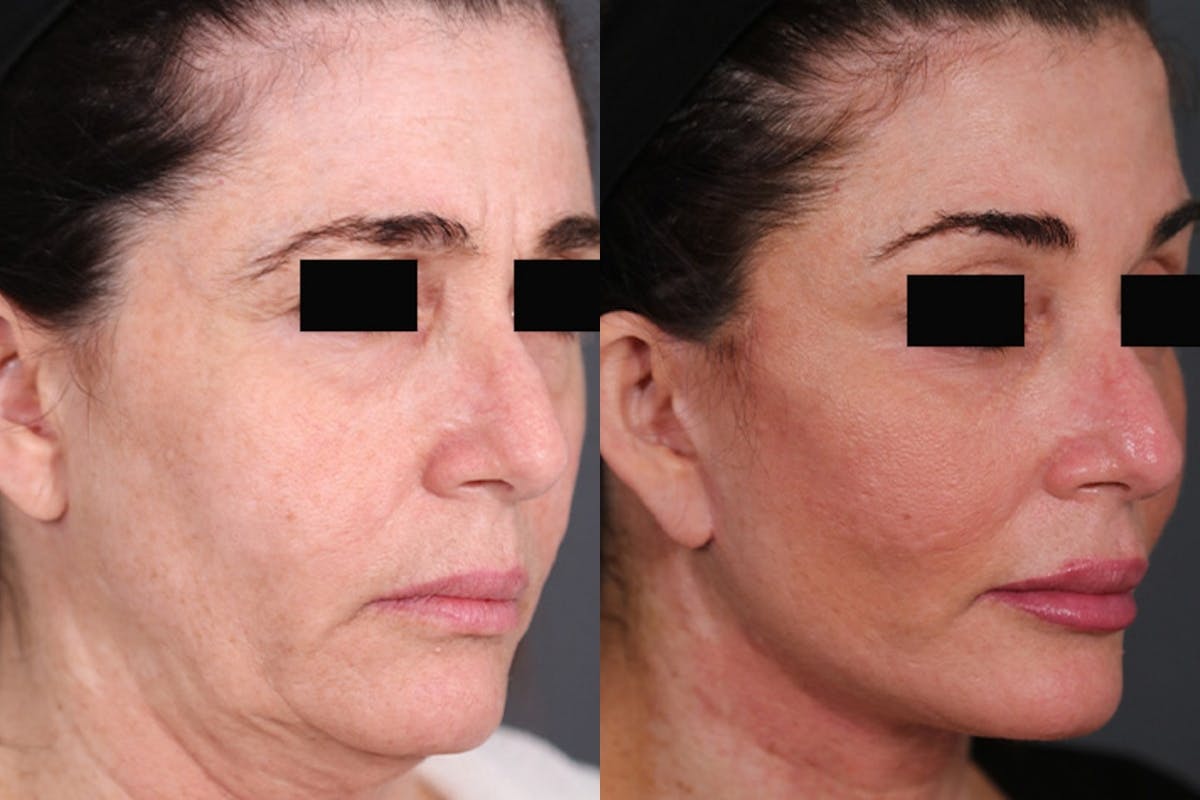 Facelift Before & After Gallery - Patient 344387 - Image 1