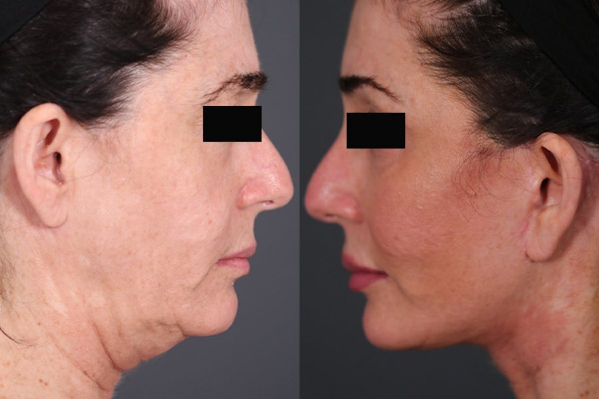 Facelift Before & After Gallery - Patient 344387 - Image 2