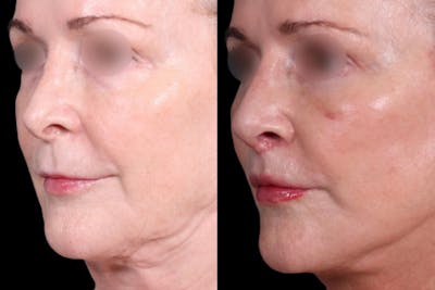 Facelift Before & After Gallery - Patient 328973 - Image 1