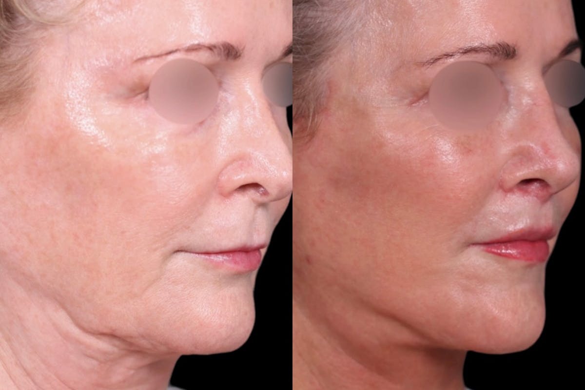 Facelift Before & After Gallery - Patient 328973 - Image 2