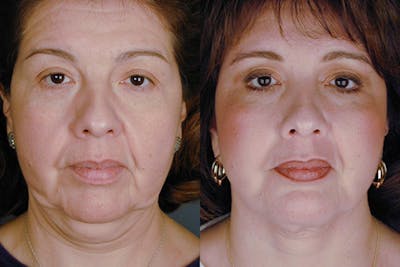 Facelift Before & After Gallery - Patient 322995 - Image 1