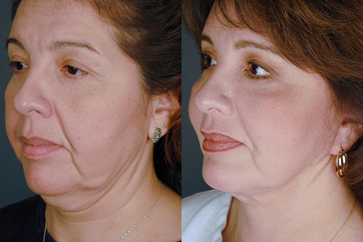 Facelift Before & After Gallery - Patient 322995 - Image 2