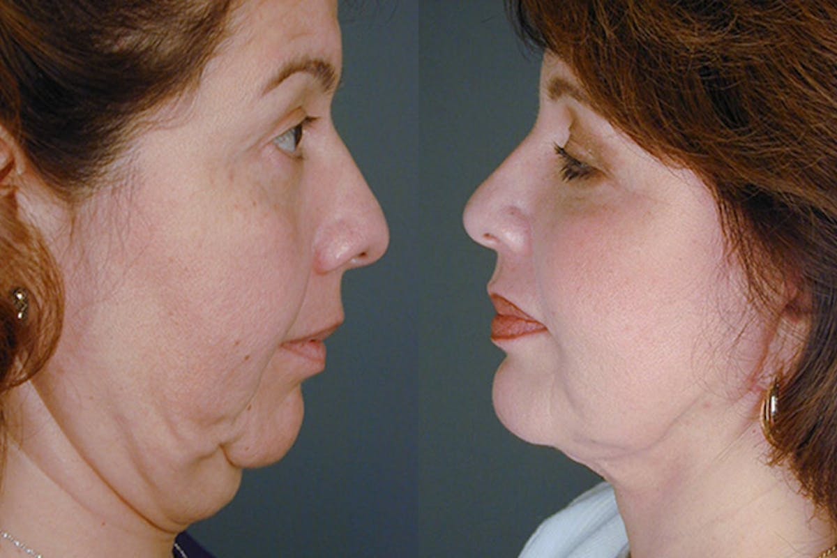 Facelift Before & After Gallery - Patient 322995 - Image 3