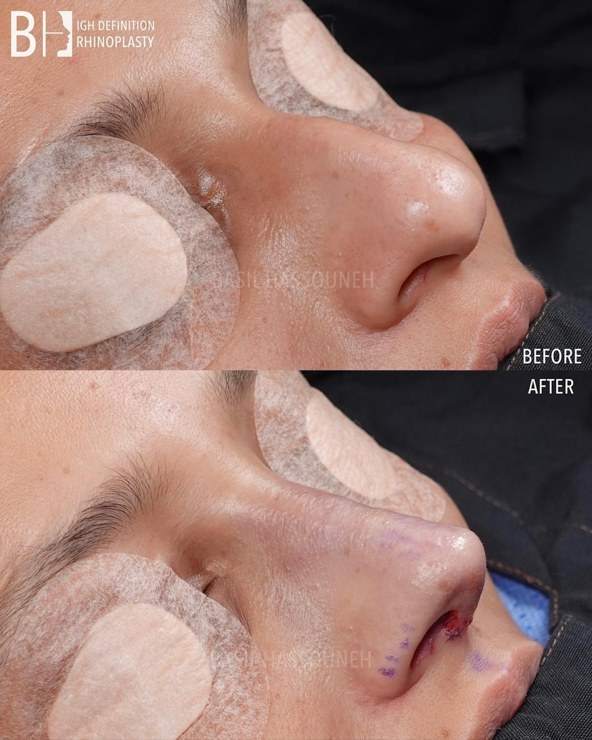 Rhinoplasty Before & After Gallery - Patient 301318 - Image 4