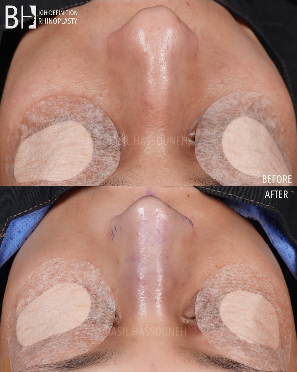 Rhinoplasty Before & After Gallery - Patient 301318 - Image 2
