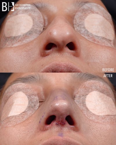 Rhinoplasty Before & After Gallery - Patient 301318 - Image 1