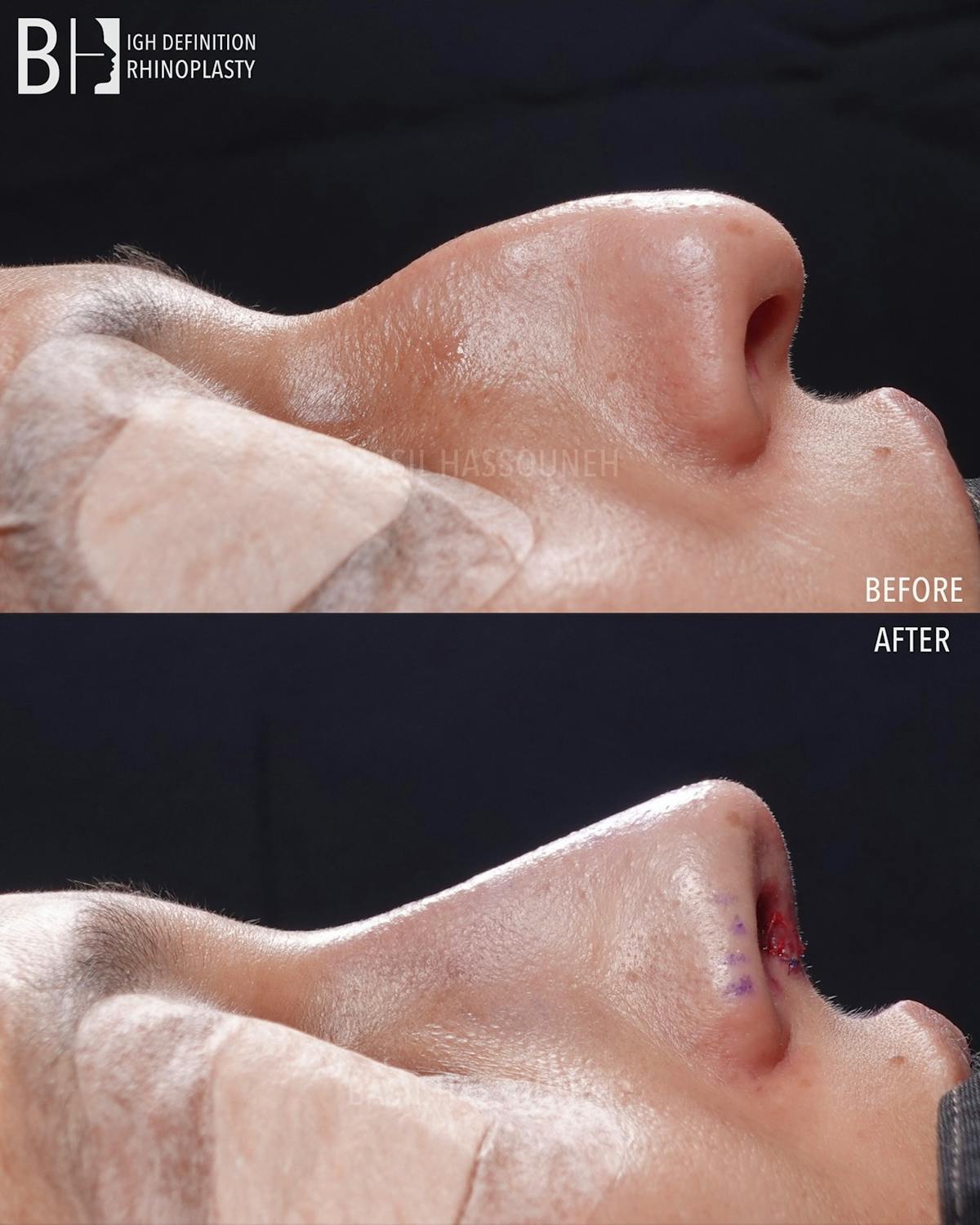 Rhinoplasty Before & After Gallery - Patient 301318 - Image 3