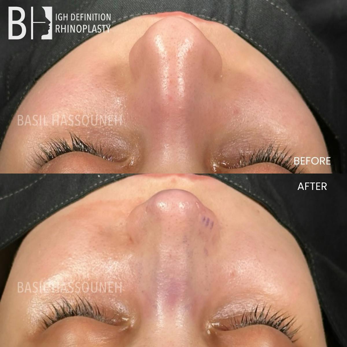 Rhinoplasty Before & After Gallery - Patient 376776 - Image 2