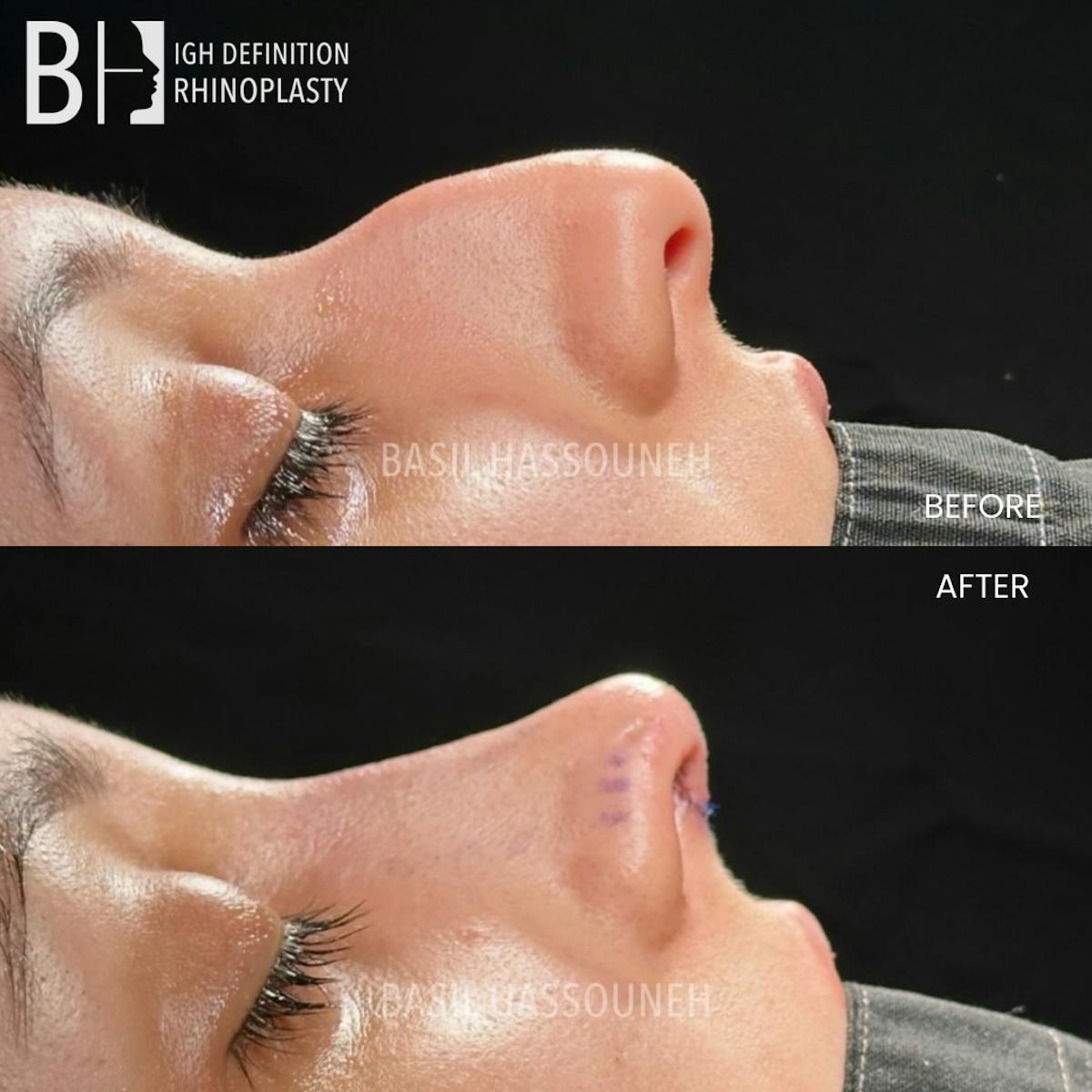 Rhinoplasty Before & After Gallery - Patient 376776 - Image 3