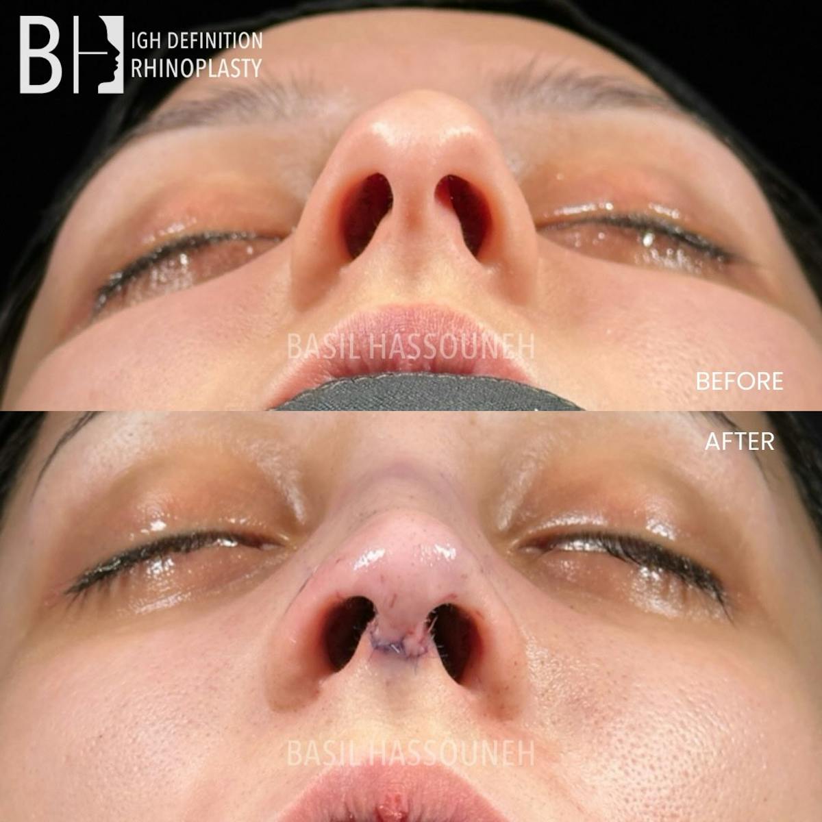 Rhinoplasty Before & After Gallery - Patient 376776 - Image 1