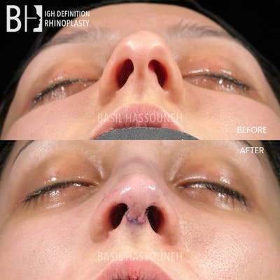 Rhinoplasty Before & After Gallery - Patient 376776 - Image 1
